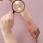melanoma