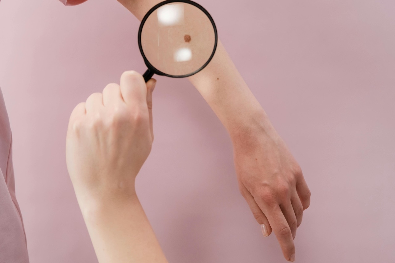 melanoma